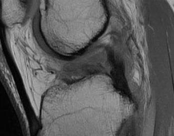 ACL PCL MRI 2